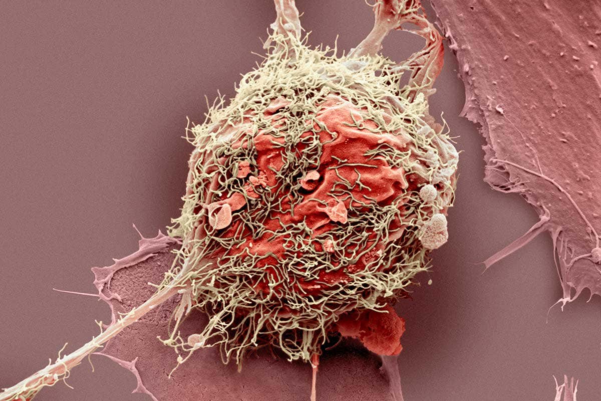 Picture of a bone cancer cell