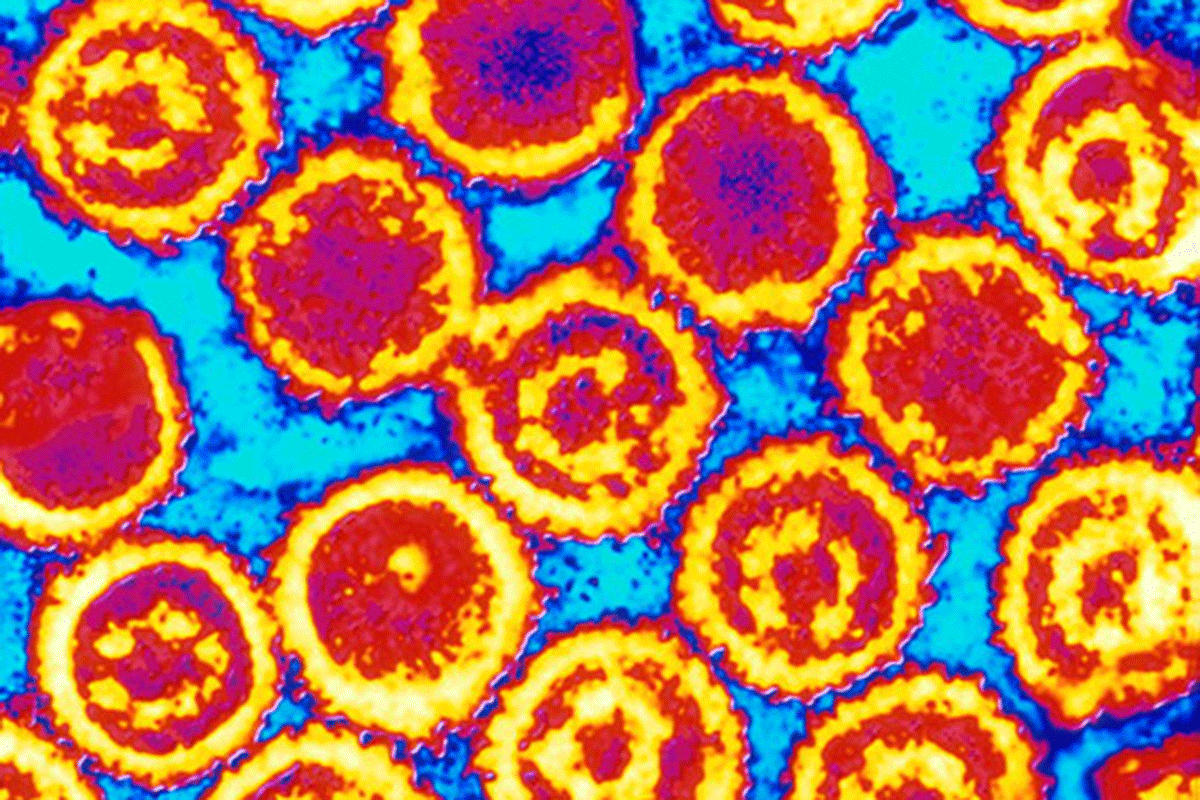 Epstein-Barr virus in lurid false colour