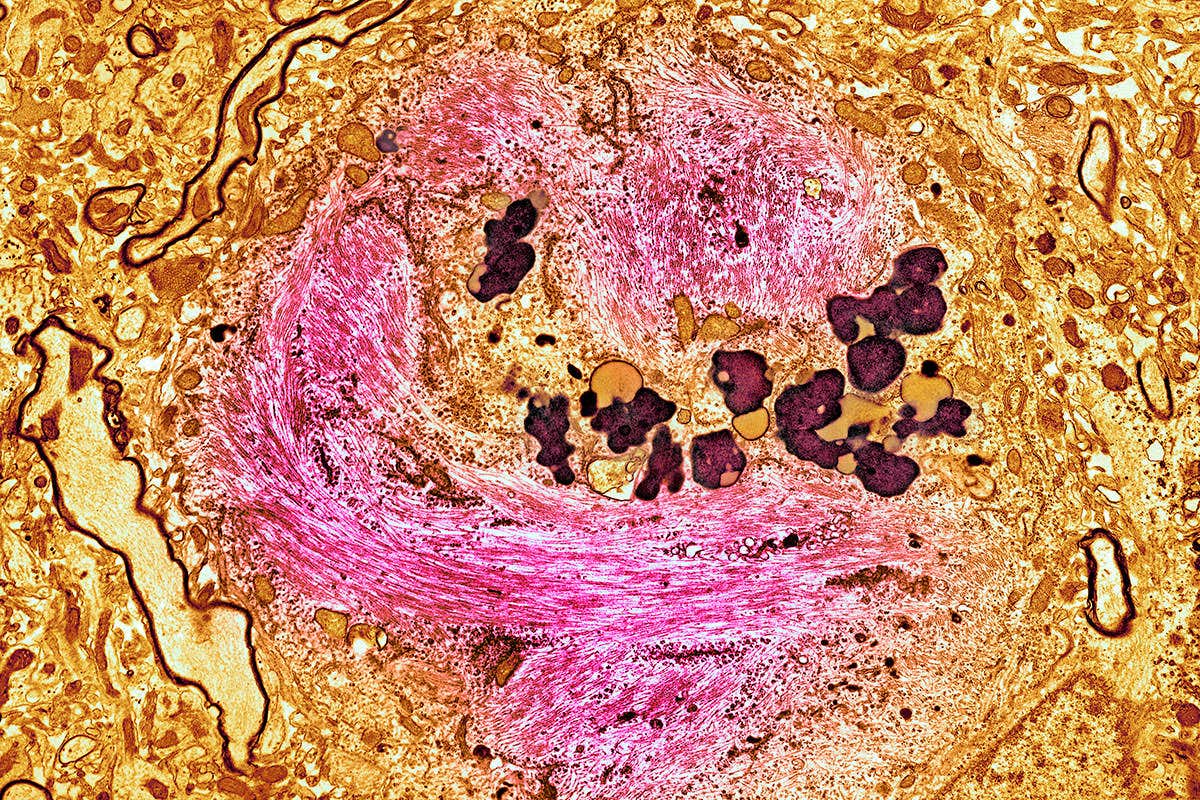 A tangle of tau protein inside a nerve cell from someone who has Alzheimer's disease