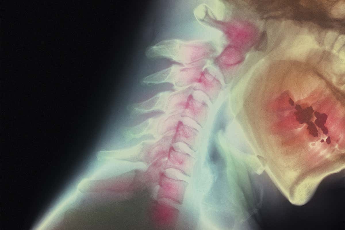 X-ray of a broken neck
