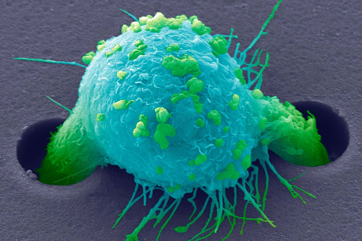 Breast cancer cell
