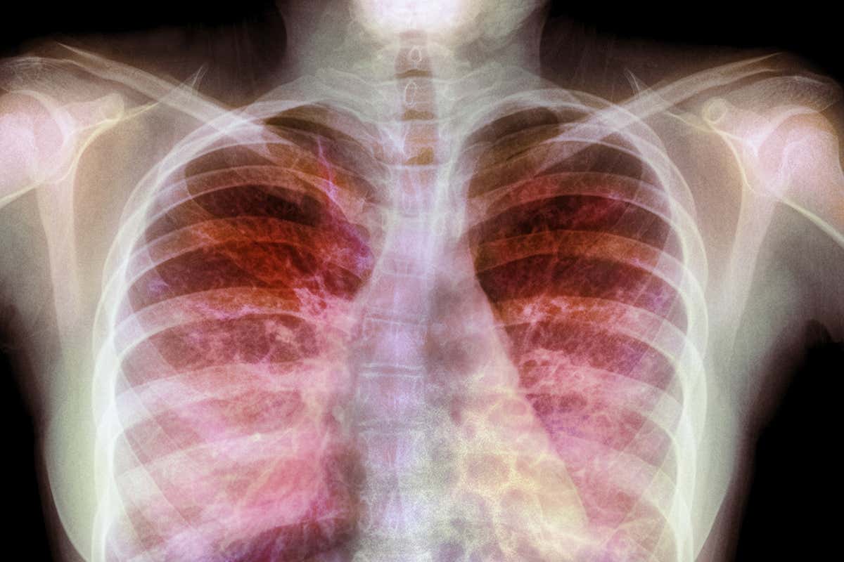 Chest X-ray of a 15 year old female with cystic fibrosis
