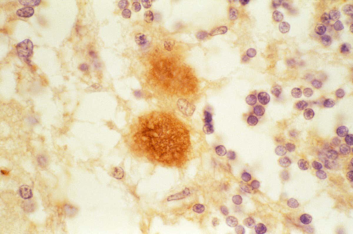 Plaques in the brain of someone who had CJD