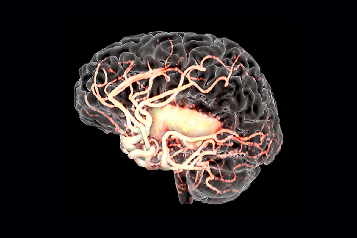 MRA image showing the effects of a stroke on a brain
