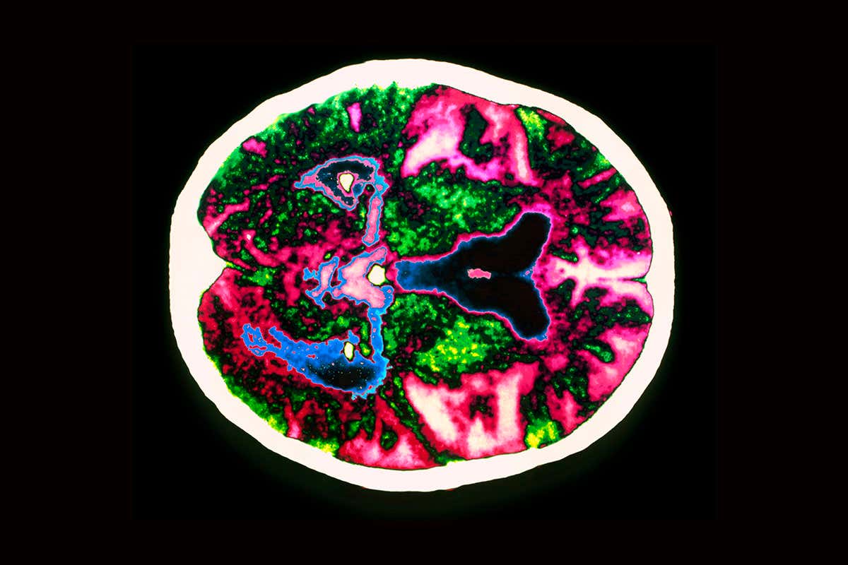 Brain scan of person with Alzheimer's disease