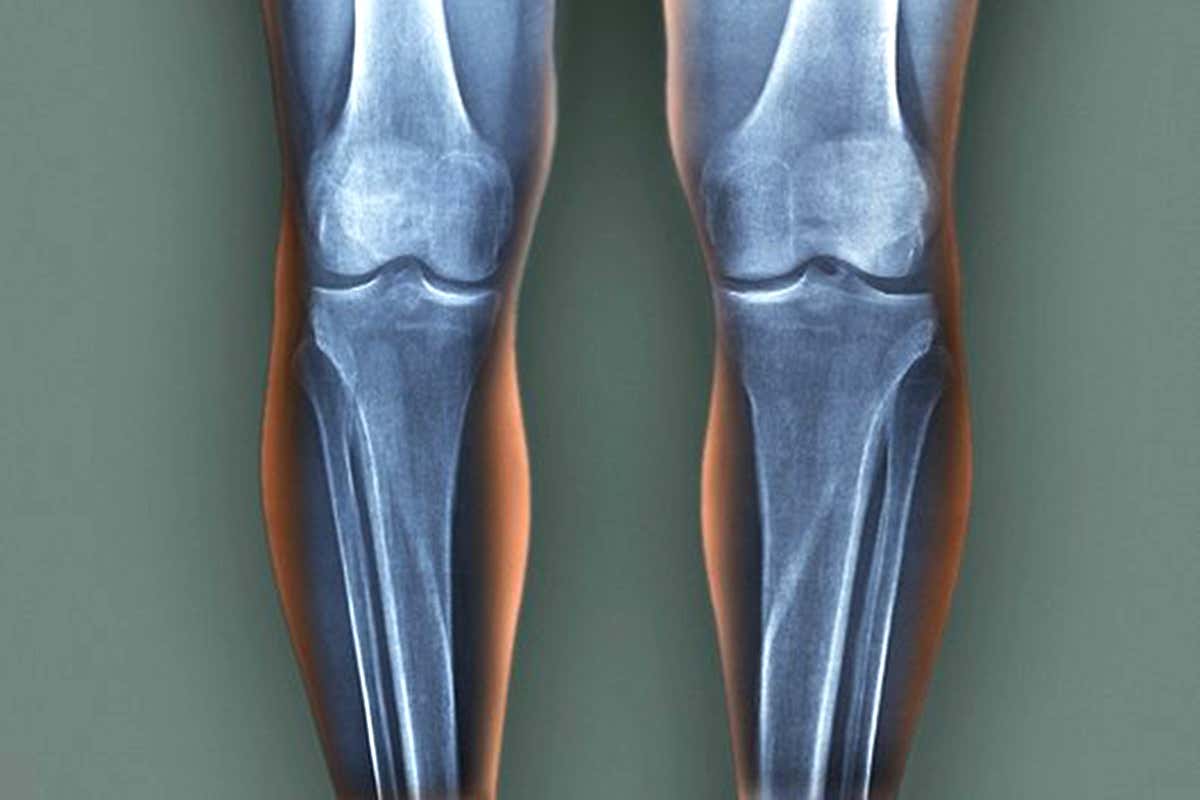 Knee X-ray