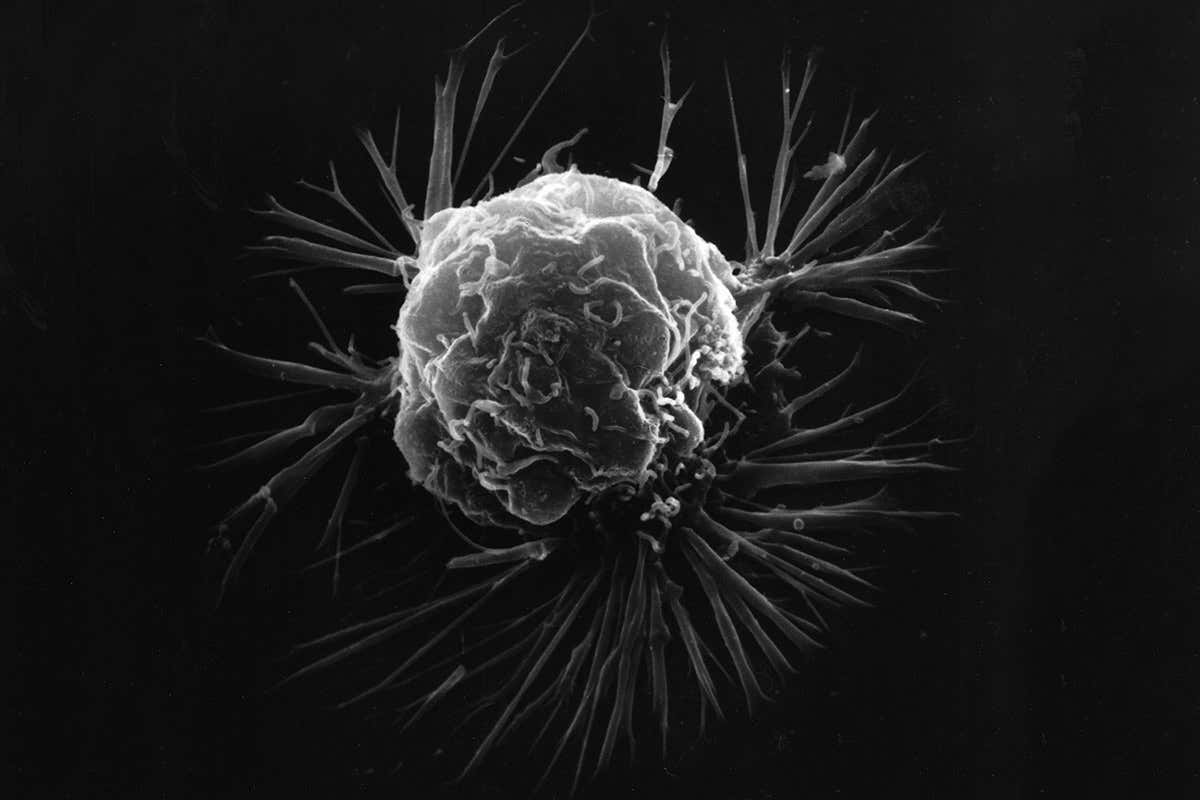 A breast cancer cell