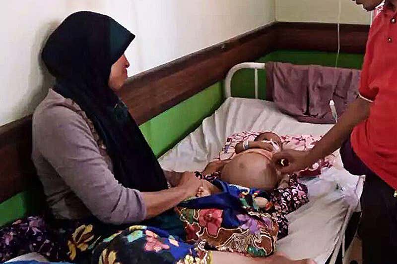 Baby has surgery to remove parasitic fetus growing inside him