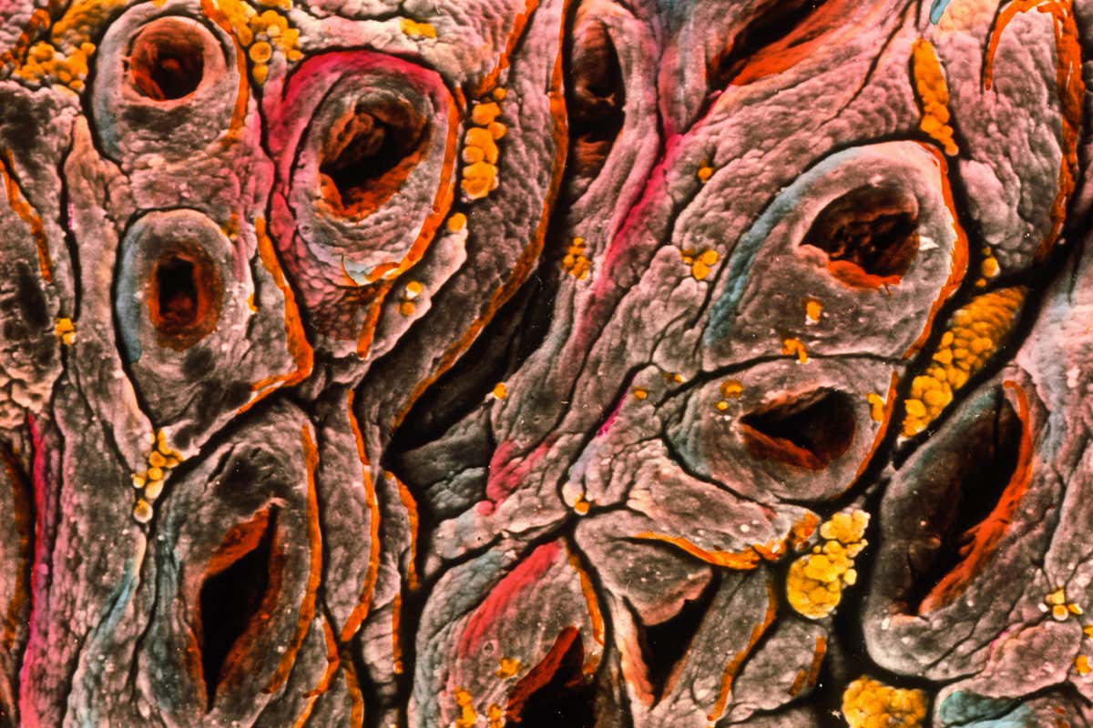 Microscope image of intestine tissue from someone with coeliac disease