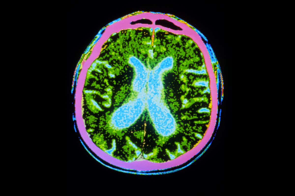 Coloured CT-scan showing the brain of a person who has Parkinson's disease