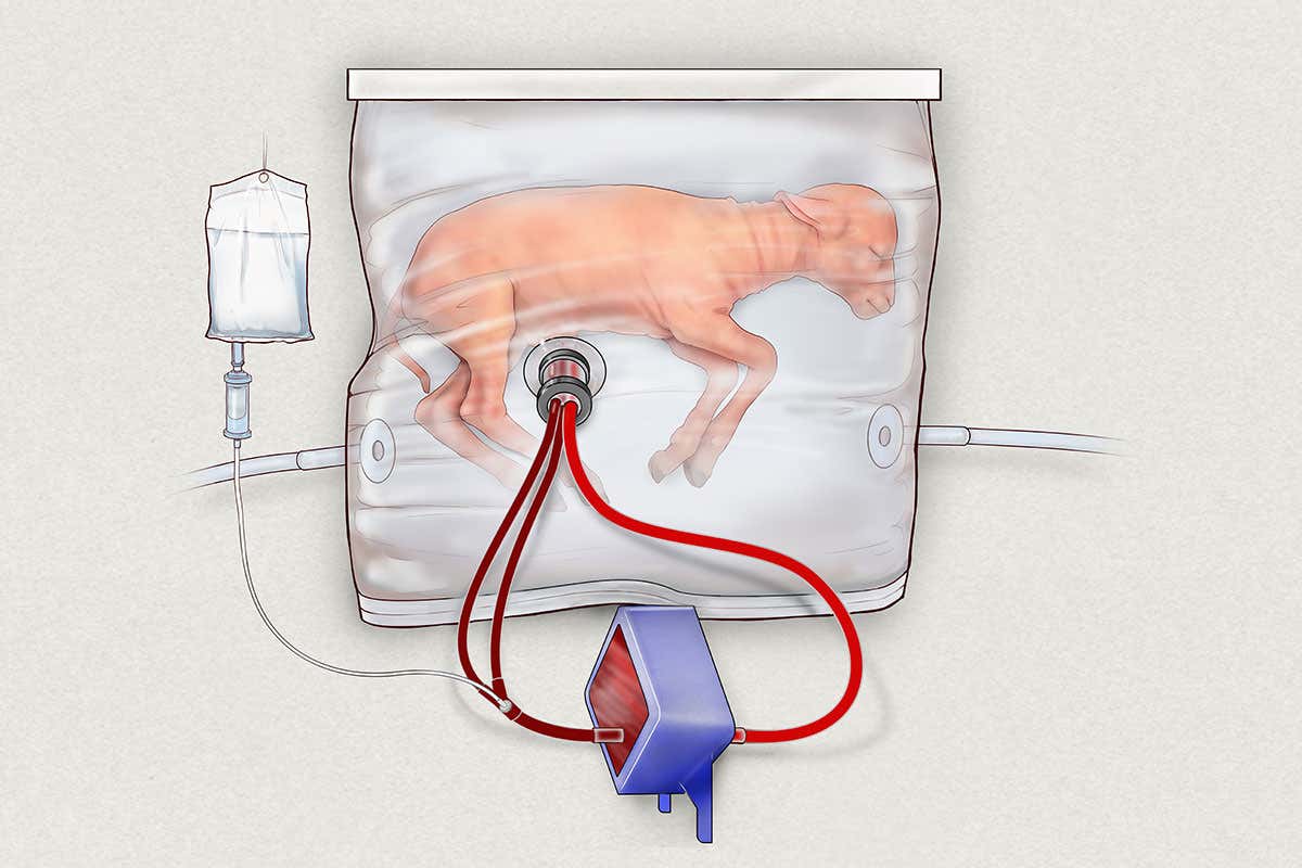 A diagram of a plastic bag system for keeping extremly premature infants alive