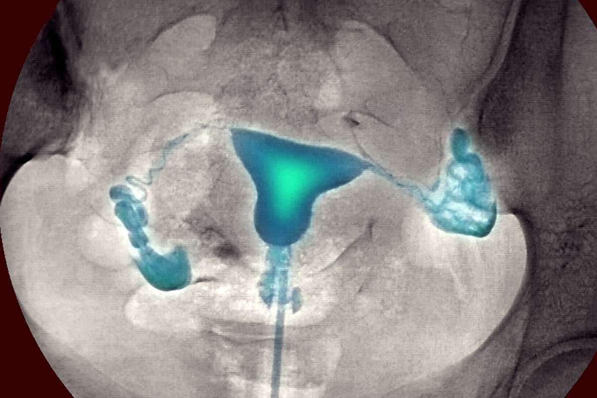 x-ray image of a woman's uterus and fallopian tubes