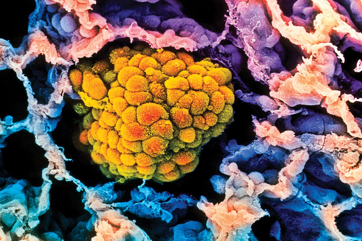 Coloured scanning electron micro- graph (SEM) of a small cancerous tumour (orange) filling an alveolus of the human lung