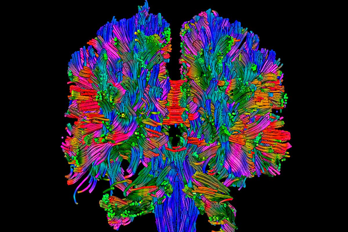 A scan of the brain