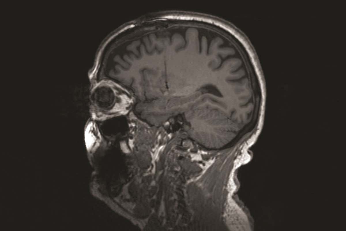 Brain scan of patient with