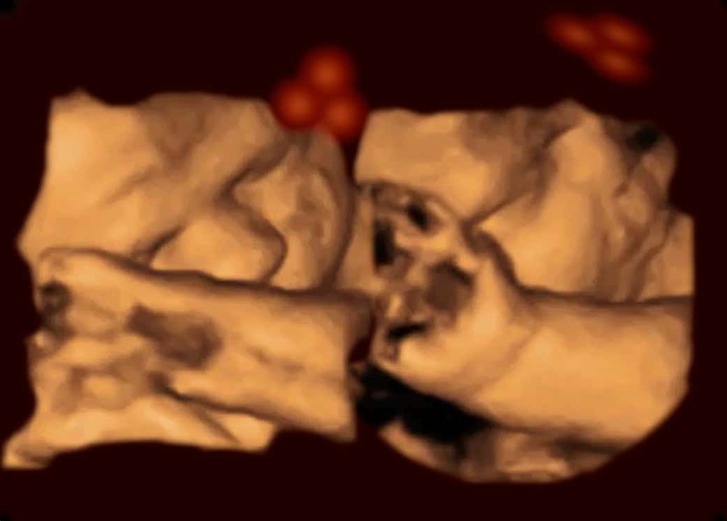 An ultrasound scan of a baby showing three red dots