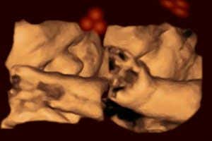 Fetuses turn to follow face-like shapes while in the womb