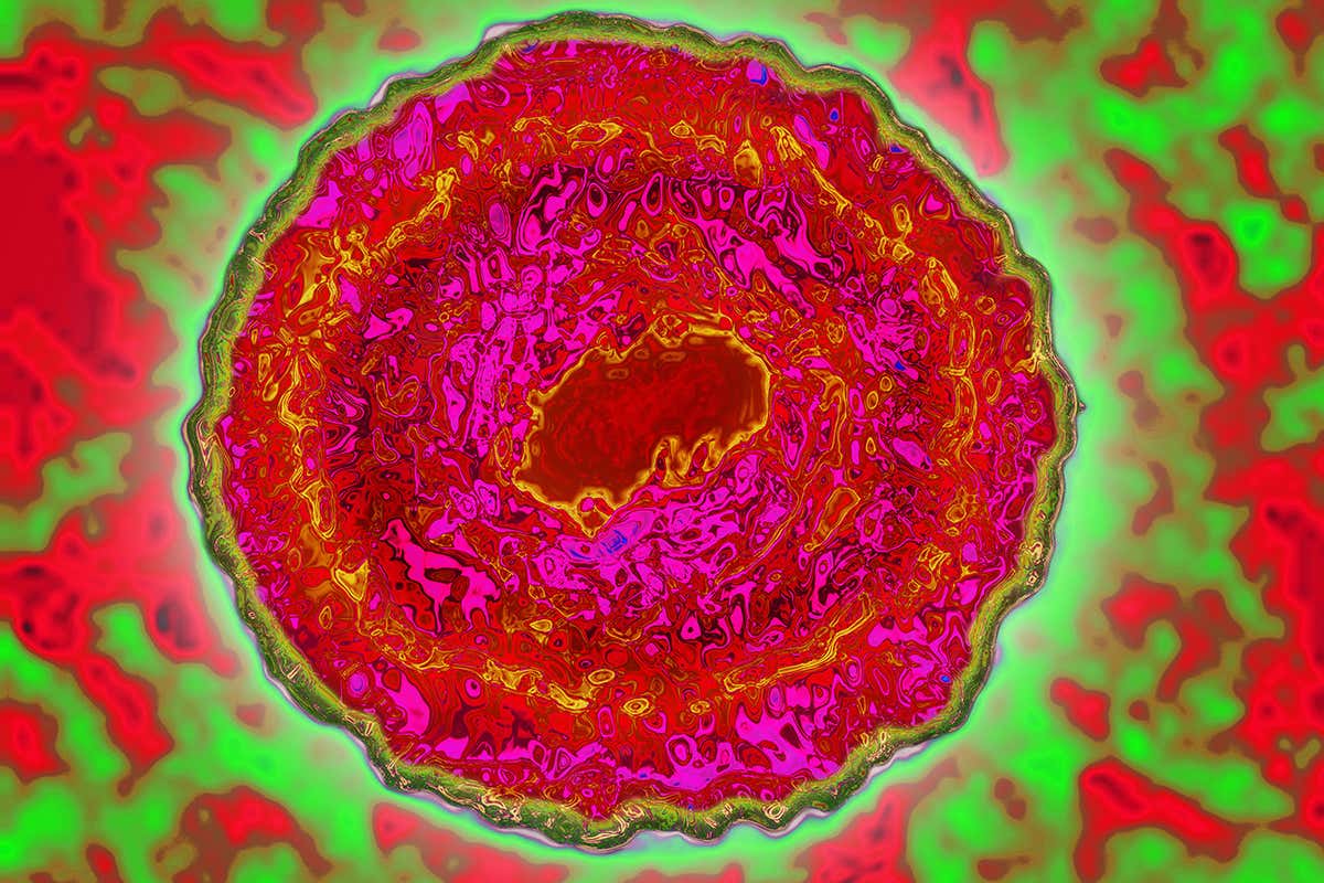 The cytomegalovirus Herpes Simplex Virus (HSV5)