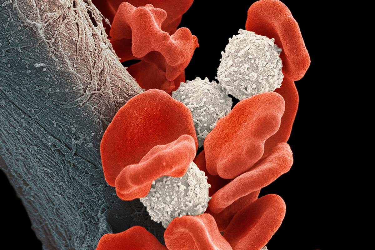 Blood cells of someone with leukaemia