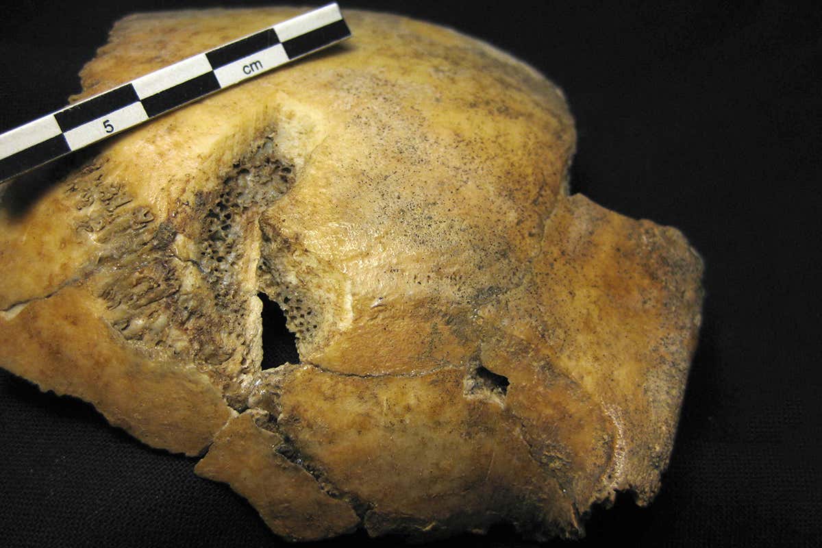 A skull fragment showing taruma