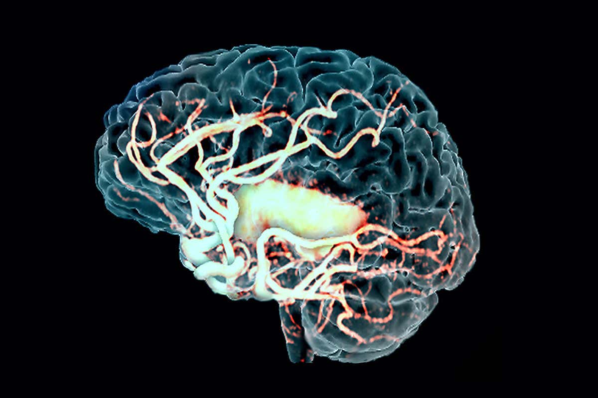 Coloured three-dimensional magnetic resonance angiogram (MRA) scan showing a human brain after a stroke