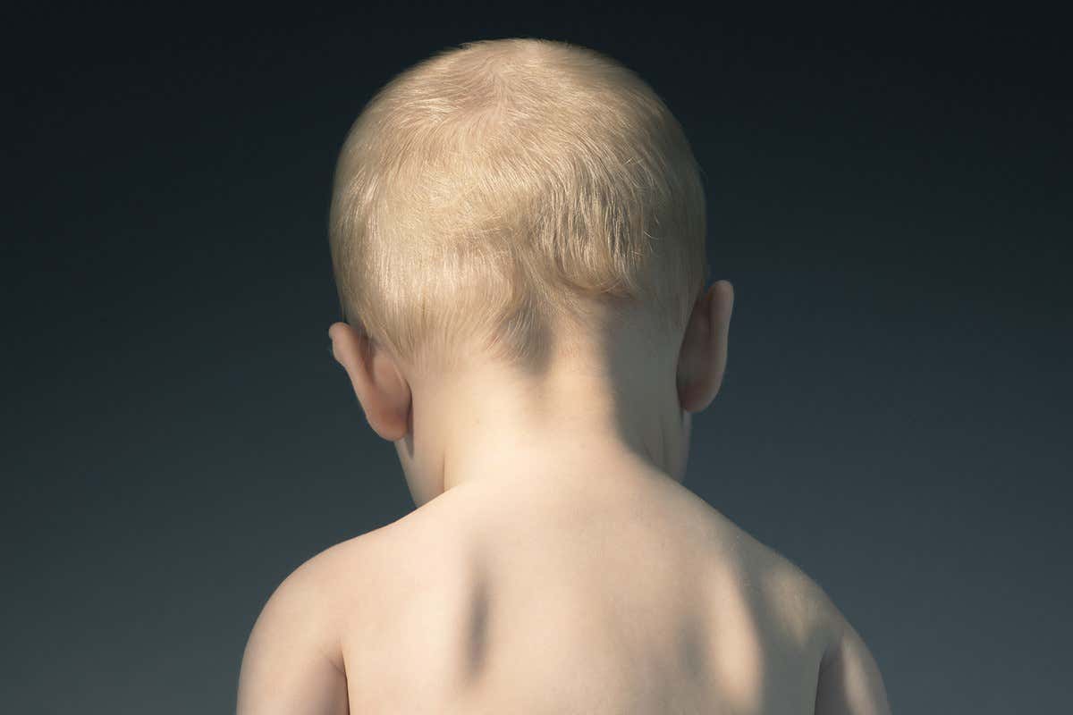 Shaken baby syndrome is not definitive proof of child abuse