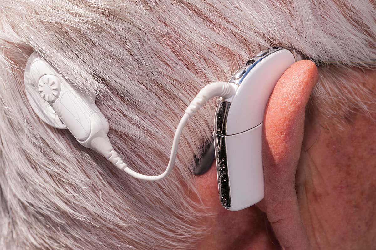a cochlear implant