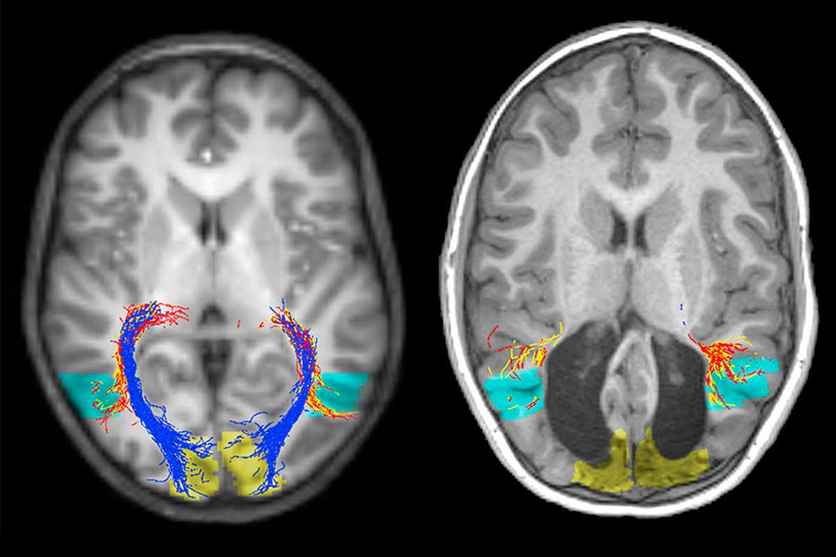 Brain scans of a normal brain (left) and the boy missing a visual cortex (right)