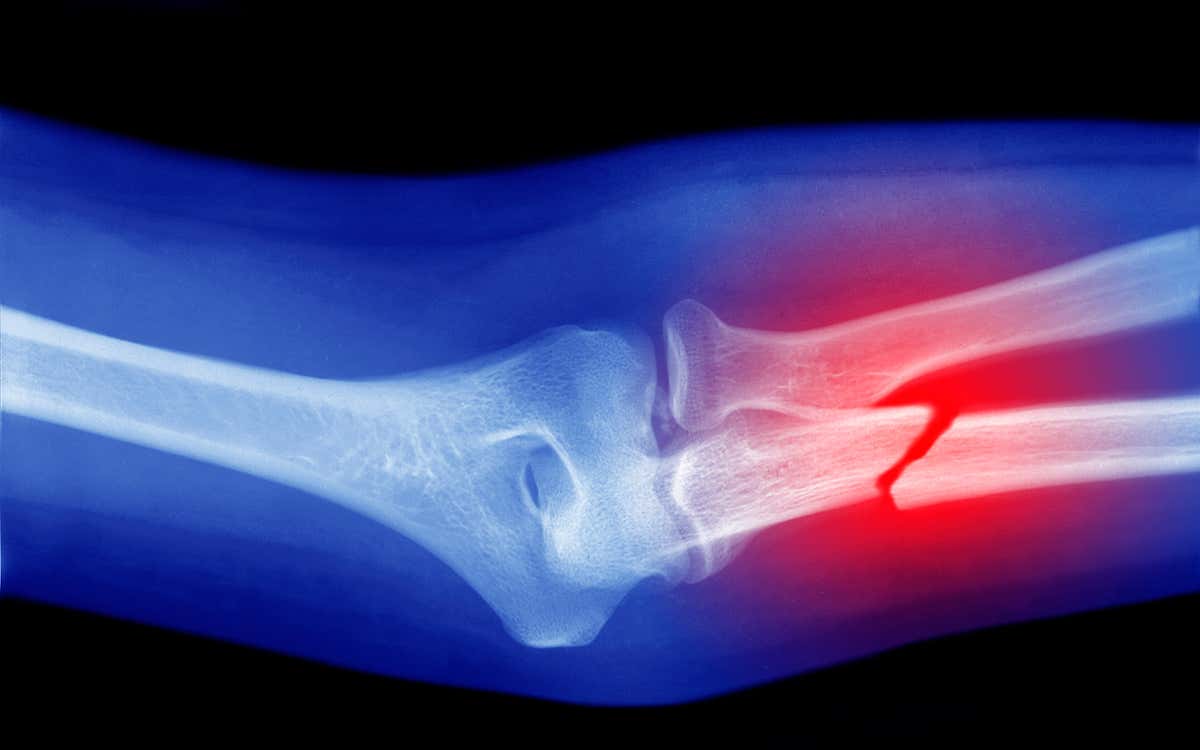An X-ray of a broken bone