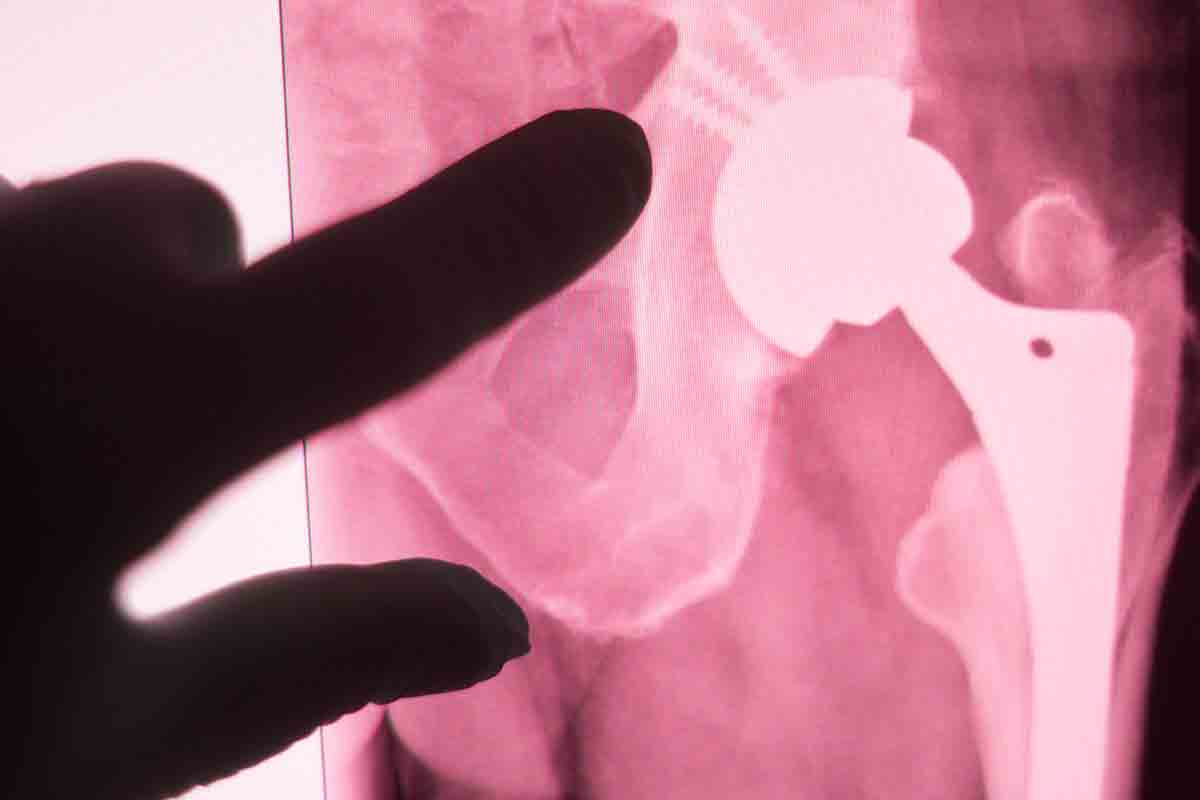 hip replacement
