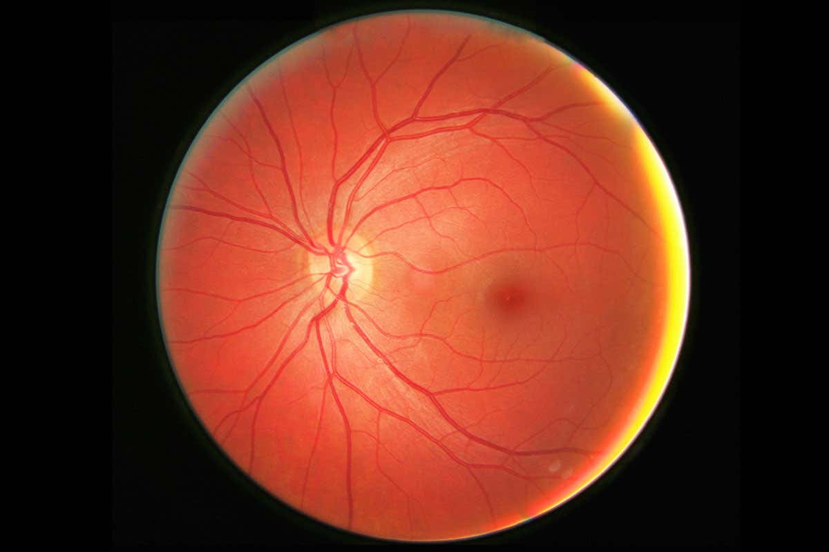 Swollen eye is setback for blindness treatment using stem cells