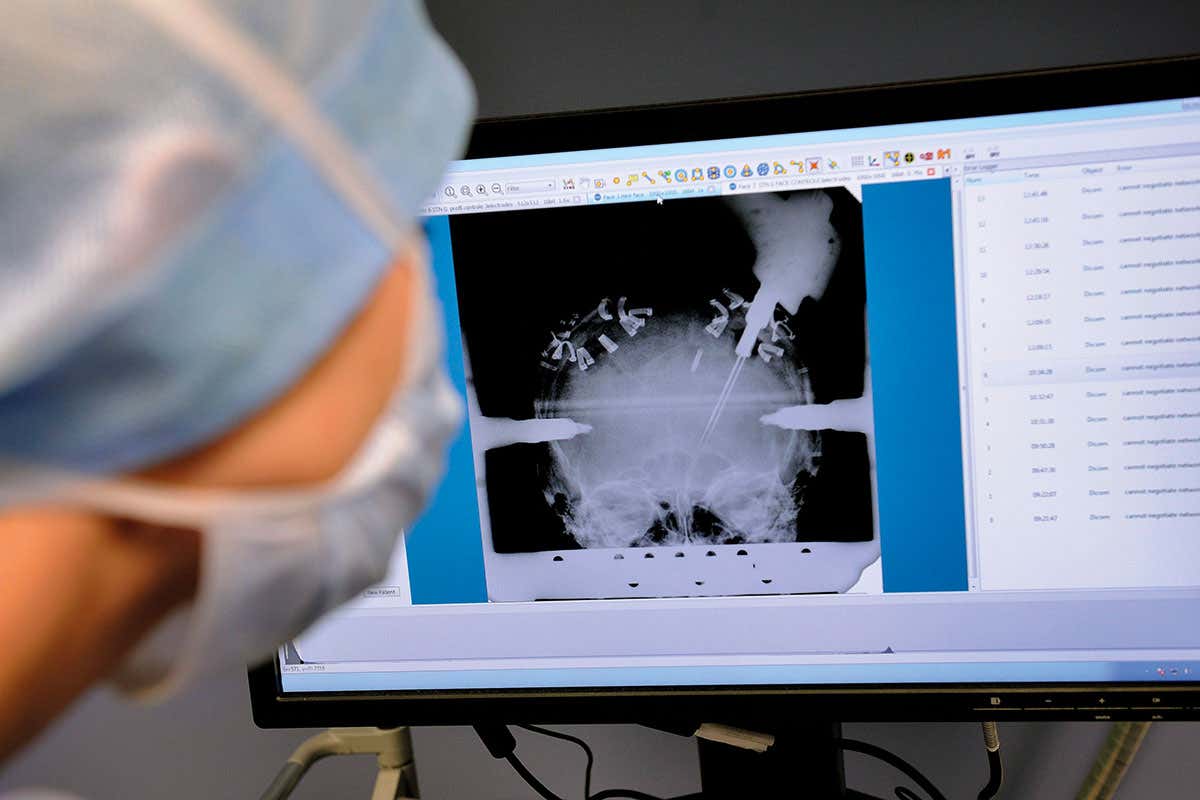 A scan showing brain implants