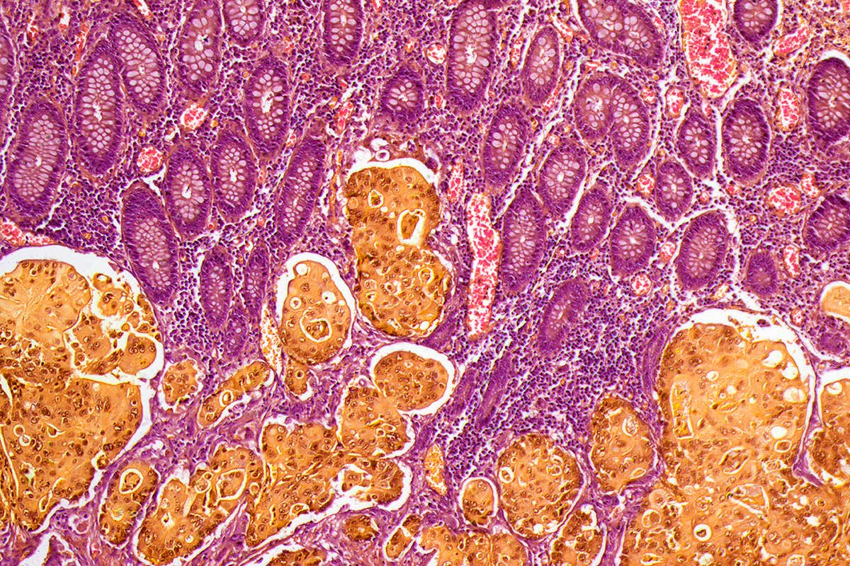 A histology slide of bowel cancer tissue