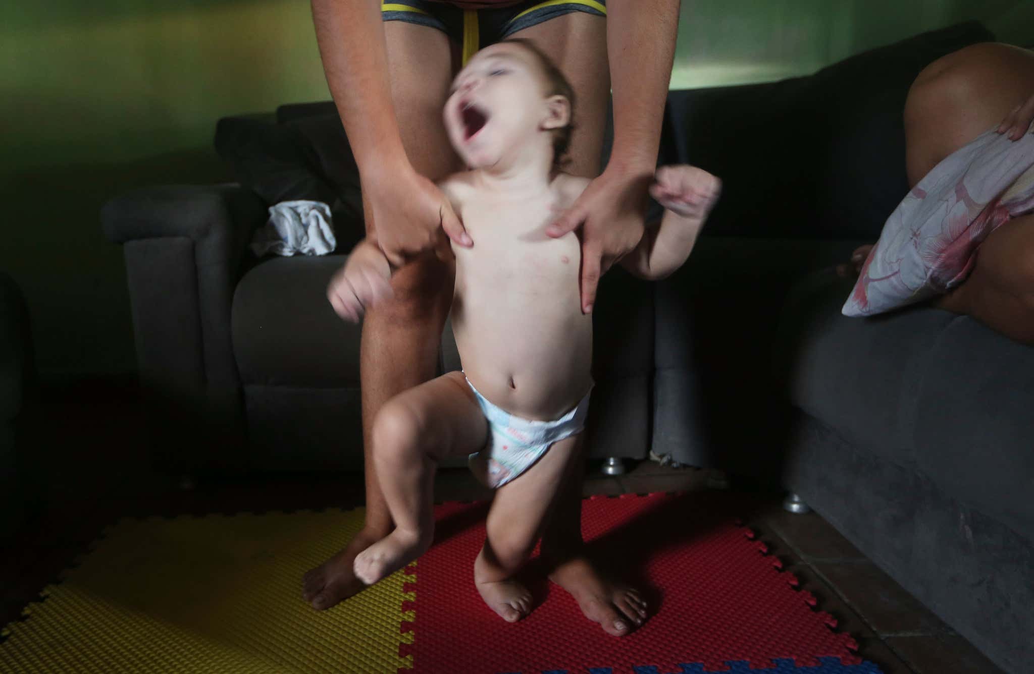 A baby with microcephaly