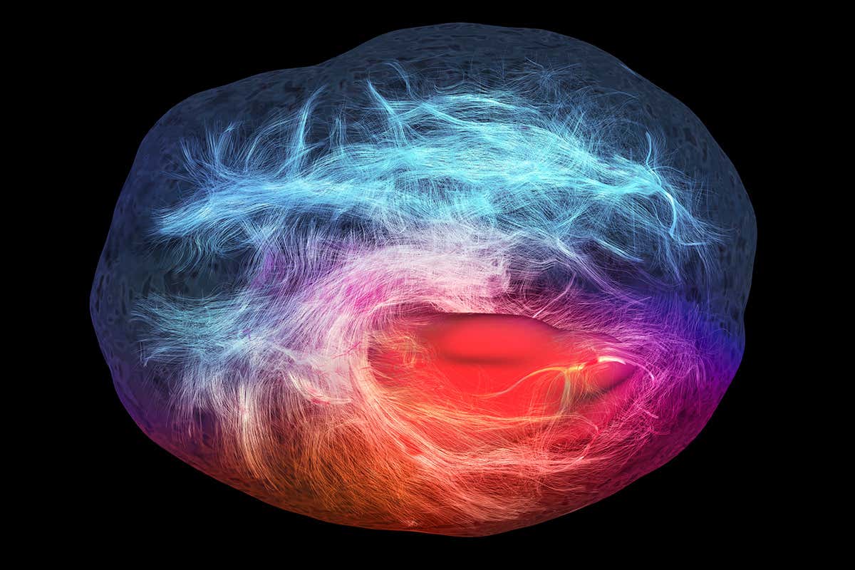 An MRI scan of a glioblastoma tumour
