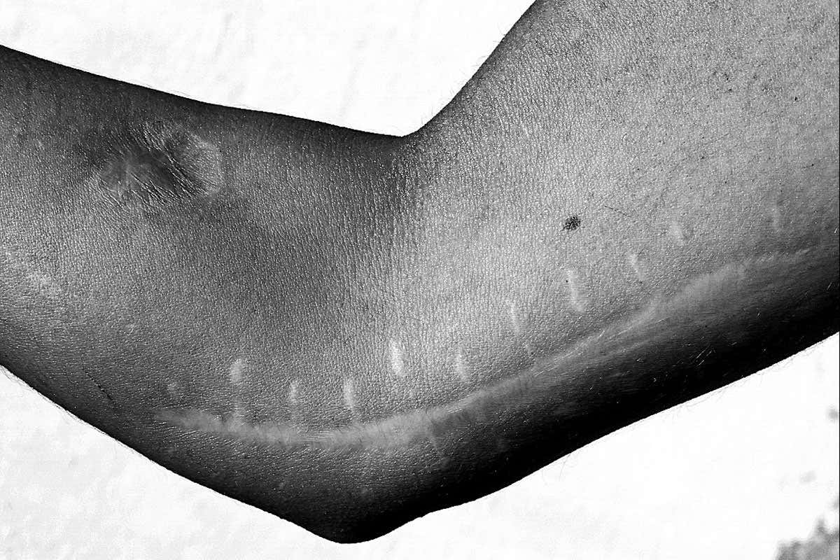 A surgical scar on a person's arm