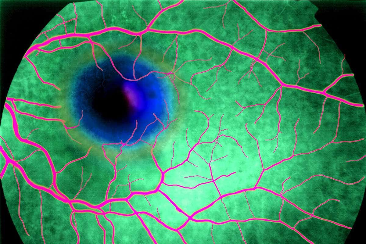 Age-related macular degeneration