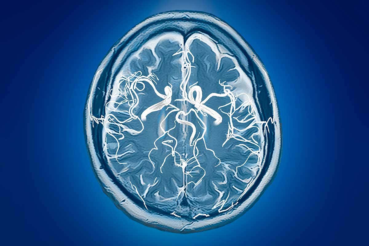 A scan of a brain and its blood vessels