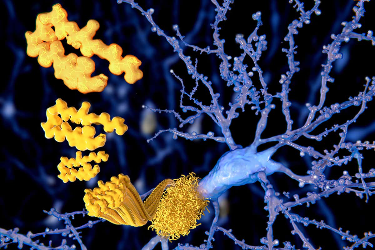 Protein deposits in the brain