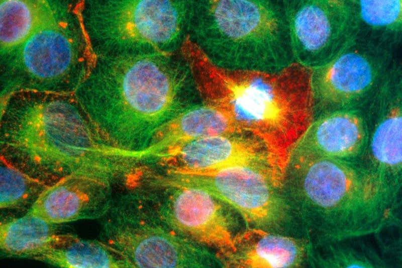 Theresa May pledges £75 million for prostate cancer research