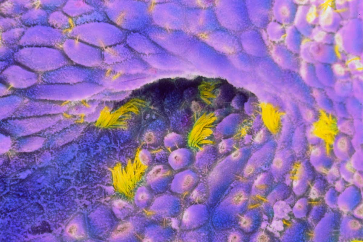 An electron micrograph of ovarian cancer cells