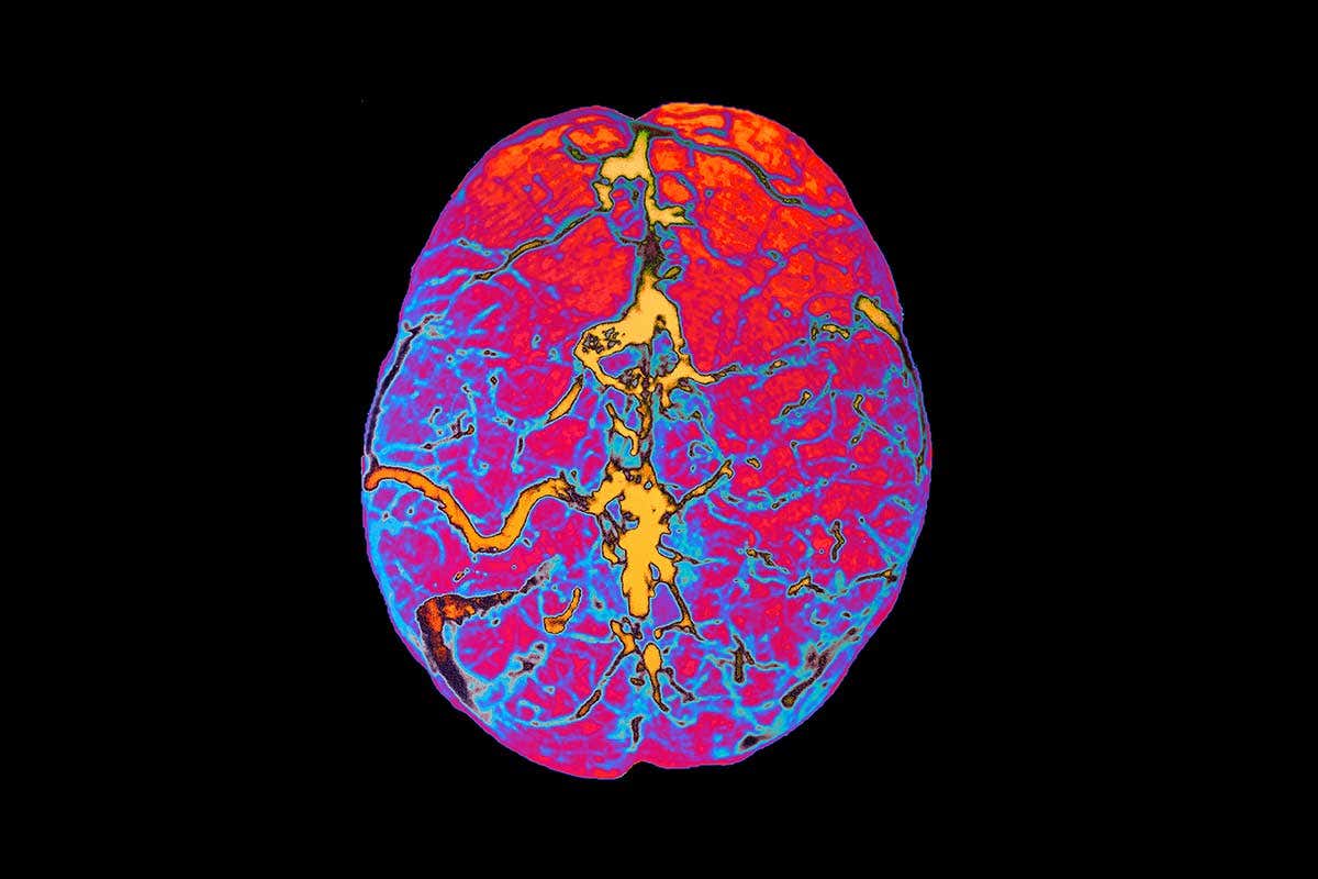 A scan of a brain