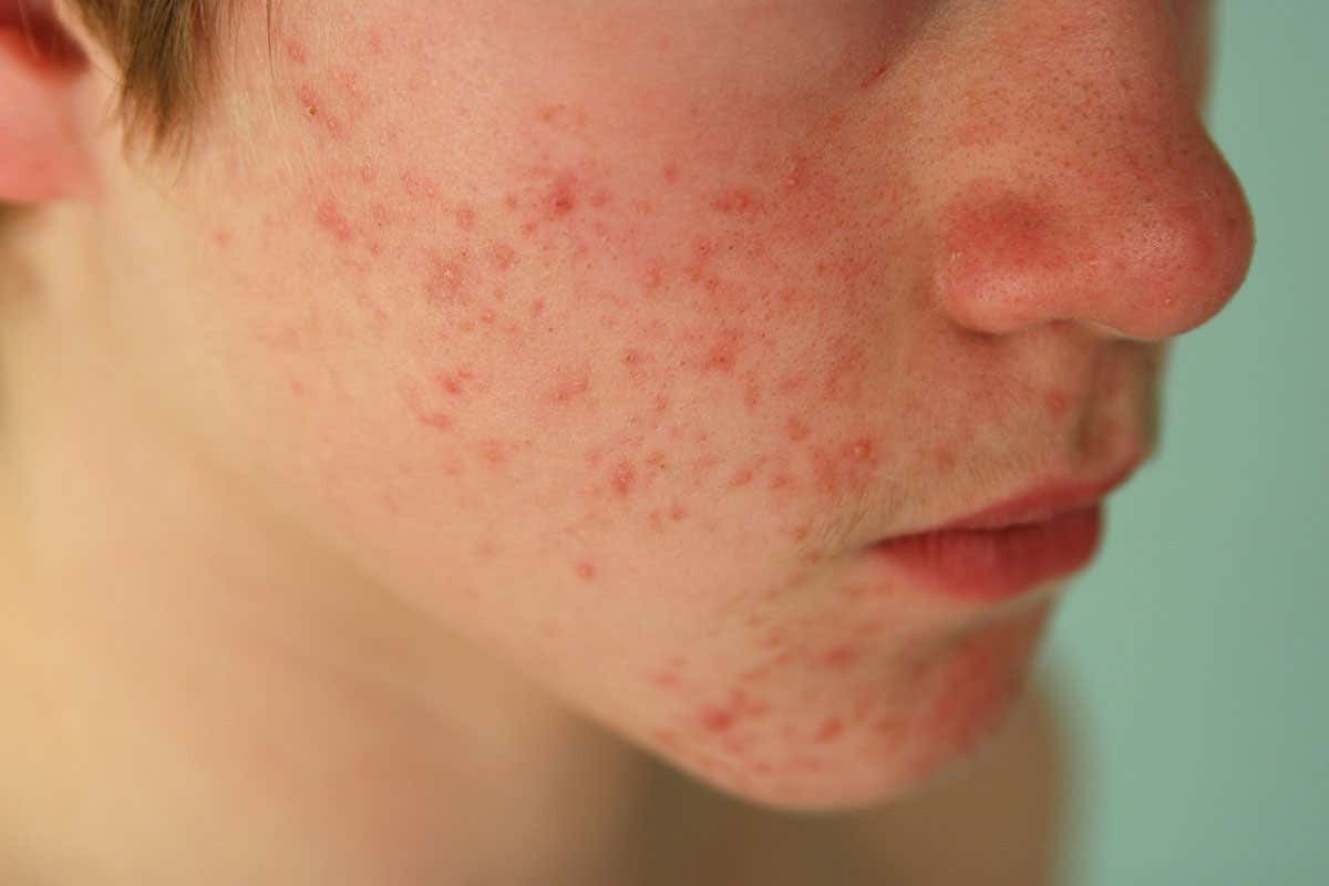 A person with acne
