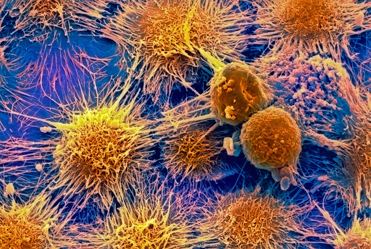 Kidney cancer cells