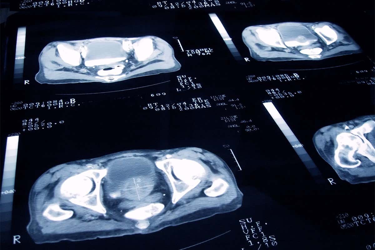 Black men are left out of cancer trials because of their biology