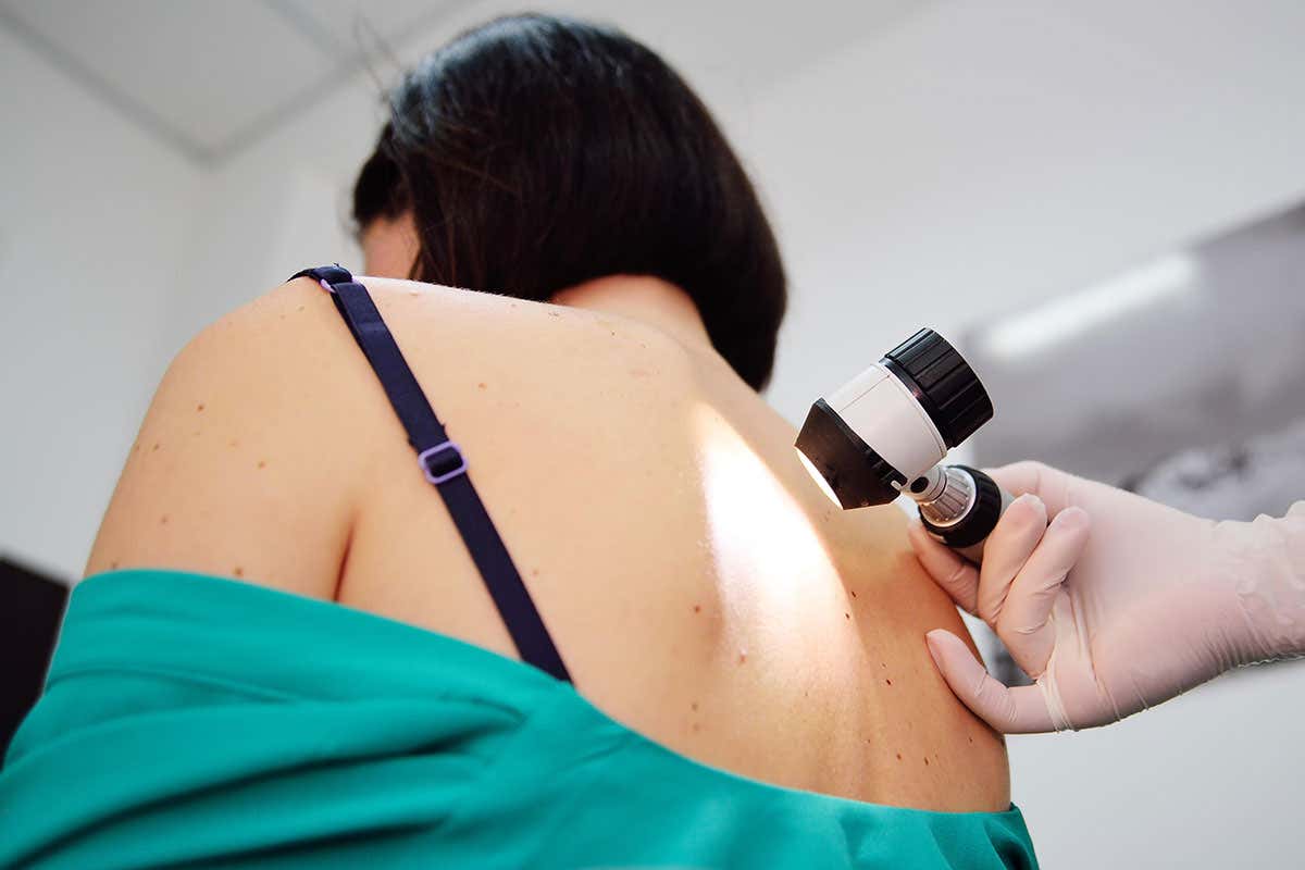 Blood test detects melanoma skin cancer while it’s easily treatable