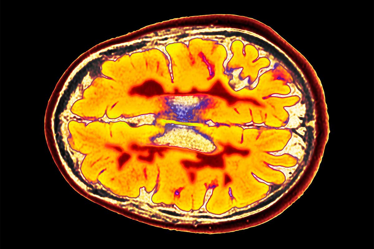 Multiple sclerosis drug is first to dramatically cut brain shrinkage