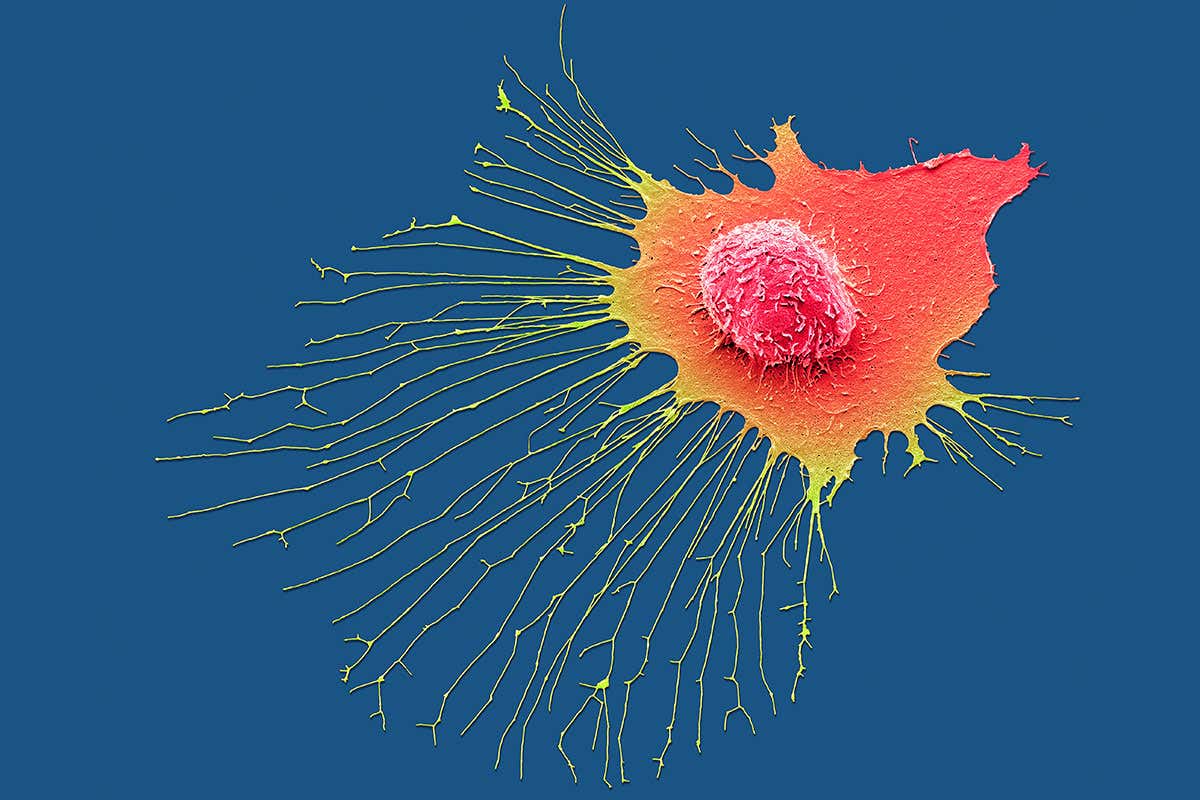 Breast cancer cell