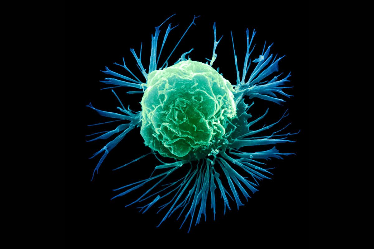 A breast cancer cell