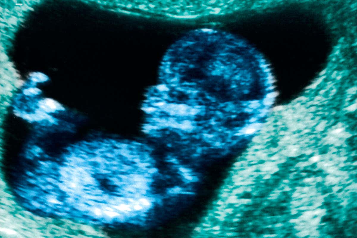 A 12-week scan of a fetus